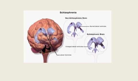 SCHIZOPHRENIA
